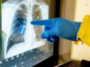На Львівщині медики фіксують перші випадки безсимптомного двобічного запалення легень